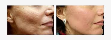 Fraxel® lasers are more effective for acne scars, including rolling, boxcar, and icepick scars, than any topical treatment currently available. Acne Scars Treatments Fraxel Laser Acne Scars 733x245 Png Download Pngkit