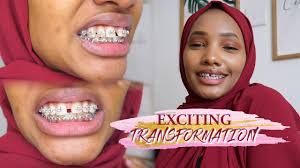 Celebrities who tested positive for coronavirus. Braces Update Do I Regret It 3 Months Braces In Kenya 2020 Youtube