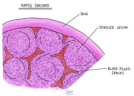 Image result for Sarcoma