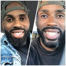 How do i fix flared teeth nope. Smiledirectclub Actual Customer Reviews Before After The Grin Life