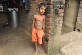 Parasitic twin)‏ هو التوأم الأصغر من توأمين متلاصقين غير متكافئين ، وهو غير قادر على العيش بشكل مستقل بذاته وإنما يعتمد في نموه على أخيه التوأم الأكبر ، وفي هذا النوع من التوائم يظهر للمولود (التوأم الأكبر) أطراف إضافية أو رأس إضافي أو جذع إضافي. Ù…Ø§ Ù‡Ùˆ Ø§Ù„Ø·ÙÙŠÙ„ÙŠ Ø§Ù„ØªÙˆØ£Ù…