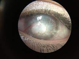 Corneal Neovascularization And Scarring Due To Over Wearing Contact Lenses Photo By Jim Thompson Photos Of Eyes Optometry Medical Photography