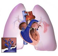 Z effective and iodine maps provide lung perfusion assessment. Pulmonary Hypertension Wikipedia