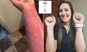 These types of burns sometimes leave a scar. Woman 28 Who Suffered Severe Burns When Pressure Cooker Exploded Has Been Healed By 8 Milk Udder Cream Daily Mail Online
