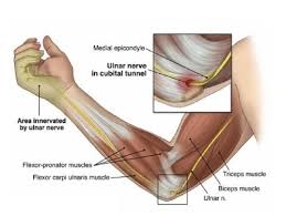 Cubital Tunnel Syndrome Numbness And Tingling In The Ring And Small Fingers Ulnar Nerve Nerve Entrapment Cubital Tunnel Syndrome