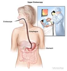 Abdominal pain or discomfort (may be vague or mild) Gastric Cancer Treatment Pdq Treatment Patient Information Nci Cs Mott Children S Hospital Michigan Medicine