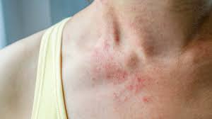 Maybe you would like to learn more about one of these? Dust Mite Bites Pictures Symptoms Treatment Prevention
