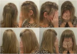 By integrating a hair replacement system into the existing hair, trichotillomania suffers can disguise the problem which can help distract the obsessive compulsive disorder. Trichotillomania Beauty By Sheila