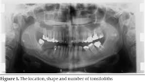 Image result for Tonsillolith