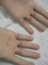 It occurs on both hands. Subcorneal Hematomas In Excessive Video Game Play Mdedge Dermatology
