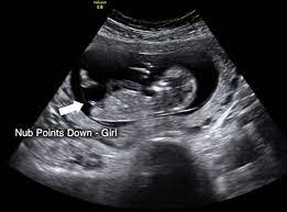 Gender Scan | Diagnostic Ultrasound Services | Pregnancy Scans