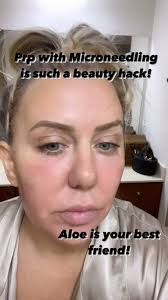 Prp is my favorite procedure! Microneedling is great to resurface the skin!  ,