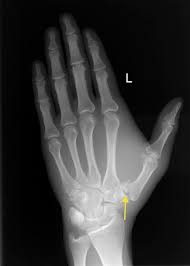 Image result for Hand Fracture