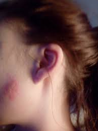 Gurtelrose Oder Etwas Anderes Gesundheit Und Medizin Medizin Haut