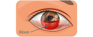 Image result for Hyphema