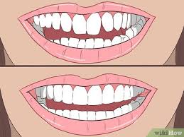 For teeth to move properly, the dentist also needs to make some adjustments in the office. How To Straighten Your Teeth Without Braces With Pictures