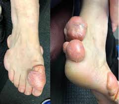 Xanthoma - Causes - Diagnosis - Best treatment Option | Homeopathic | Best Homeopathic Doctor in Pakistan | Dr Qaisar Ahmed MD, DHMS