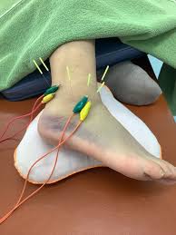 下駄 骨折 テーピング