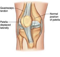 Image result for Patellar Dislocation