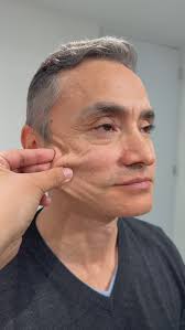 Full face y biosensores en la misma sesión , Que bioestimulacion aplicamos  en este caso?