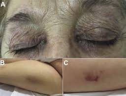 Elderly Woman With Purple Rash On Eyelids