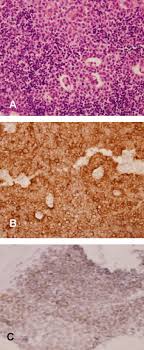 Myasthenia Gravis In Ectopic Thymoma Presenting As Pleural Masses Sciencedirect