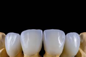 Oct 31, 2019 · dental insurance may cover all or part of the cost of your crown. How Long Do Dental Crowns Last On Front Teeth