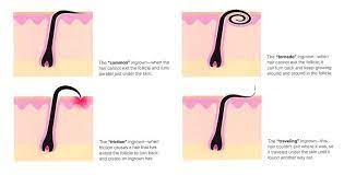 Ingrown hairs are quite common in men who keep a very short stubble, thereby allowing the sharp end of the cut hair to actually penetrate the skin. How To Treat Ingrown Hair