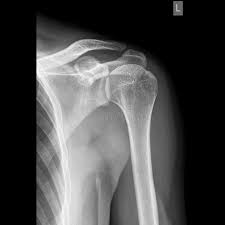 Image result for Shoulder XRay