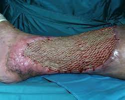 Ulcus Cruris Op Zentrum Orthopadie Chirurgie