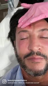 Fibroblast close up 😲🤩 Fibroblast Skin Tightening is performed using a  plasma pen and under topical anesthetic cream. An electrical arc is  discharged...