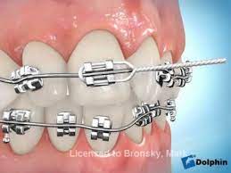 Enlaces Con Ligadura Metalica Dental Braces Braces Colors Perfect Teeth