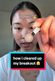 Skin Choice Breakout Patch