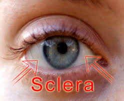 Image result for Scleritis