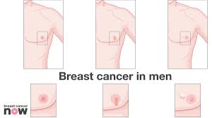 Changes to the skin covering your doctors know that male breast cancer occurs when some breast cells divide more rapidly than healthy cells do. Breast Cancer Now On Twitter Learn More About The Signs Symptoms Of Breastcancer In Men Look Out For Unusual Changes Malebreastcancer Https T Co Pfosomg13w Https T Co Hnpqlah6cr