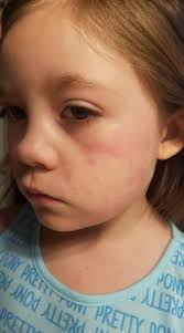 To parents that have children in KGES. There is high amount of Fifths  disease being passed around. My daughter is 1 of 8 confirmed cases in one  class. It starts with a