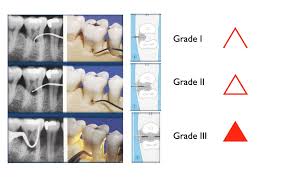 Grades Of Furcation Involvement Dentistry Dental Dental
