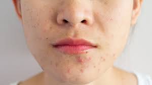 Pimples on chin can be painful, deep and blind. How To Get Rid Of Acne According To A Dermatologist Cnet