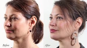 A lower facelift surgically redefines the jawline by eliminating jowls, minimizes the appearance of laugh or marionette lines, and tightens sagging cheeks. Sagging Jowls Will Be A Thing Of The Past Now