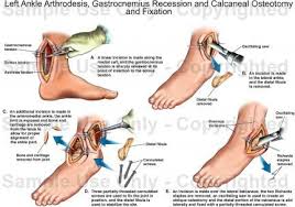 Ankle Fusion Surgery Pictures Google Search Ankle Surgery Recovery Ankle Surgery Foot Surgery Recovery