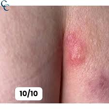 Image result for genital herpes