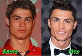 Masih terkait pesepakbola yang melakukan operasi plastik. Pilih Messi Perempuan Ini Sebut Cristiano Ronaldo Operasi Plastik Apa Benar Okezone Bola