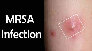But because it takes about 48 hours for the bacteria to grow, newer tests that can detect staph dna in a matter of hours are now becoming more widely available. Mrsa Infection Symptoms Causes And Methods To Cure Mrsa Infection