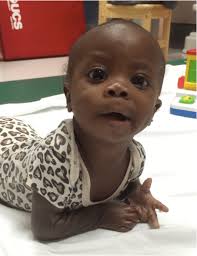 b Prone at 5 months of age, more symmetrical weigh bearing through...