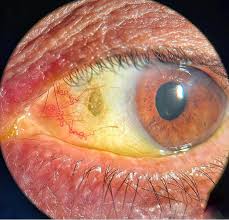 Image result for lesion sclera