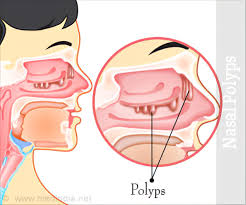 While the term 'growth in the nose or sinus' seems serious, nasal polyps are not cancerous tumors but may sometimes occur in cases of neoplasms of the nose or paranasal sinuses. Nasal Polyp Causes Symptoms Diagnosis Treatment Health Tips