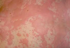 Urticaria Also Known As Hives Is An Outbreak Of Swollen Pale Red Bumps Or Plaques Wheals On The Skin That Urticaria Plaque Psoriasis Treatment Fungal Rash