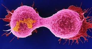 Image result for ‫۲۰ مورد مشکوک به سرطان در بانوان‬‎