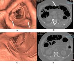 Image result for Virtual Colonoscopy