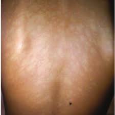 Pityriasis alba this type of disease occurs on face, upper arms, neck, or shoulders. Pityriasis Alba Extensa Pityriasis Alba Extensa Better Named Download Scientific Diagram